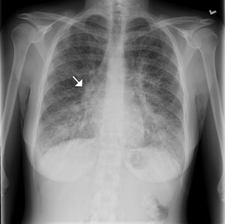 ¿Qué es una linfangitis carcinomatosa?