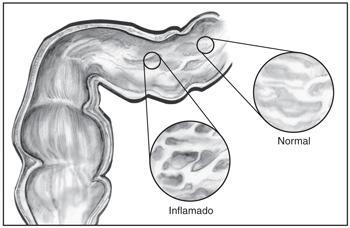 Lo que usted debe saber sobre la enfermedad de Crohn Ilustración del revestimiento del tubo digestivo.