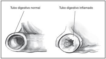 Lo que usted debe saber sobre la enfermedad de Crohn Ilustración de dos cortes transversales del tubo digestivo.