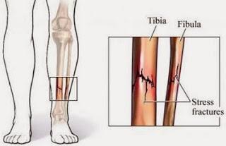 Fracturas por estrés