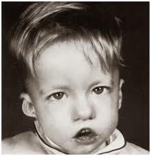 El Síndrome DiGeorge