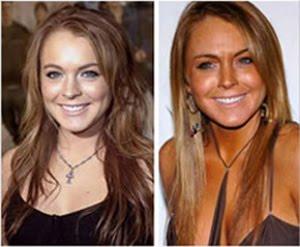 ¿ Qué es la tanorexia ?