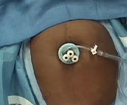 Cirugia Laparoscopica de un solo Puerto