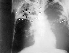 Se puede confirmar en dos horas tuberculosis en un test molecular