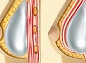 rotura implantes silicona