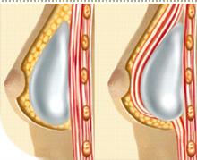 La rotura de los implantes de silicona