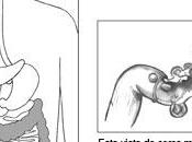 Enfermedad diverticular
