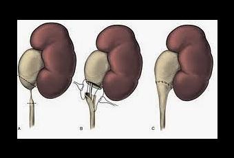 Resultado de imagen para IMAGEN PIELOPLASTIA