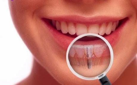 ☻5 cosas que debe saber acerca de los implantes dentales.