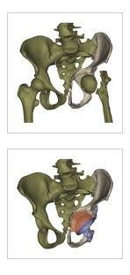 implante-3d-sacarmoldes