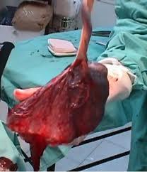 Inclusiones Placentarias Predicen el Autismo