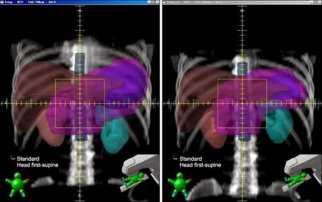 La radioterapia en el cáncer gástrico