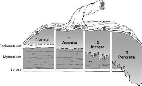 Problemas de la placenta: Acretismo y placenta previa accreta degrees, page2anesthesiology.org