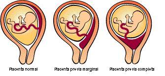 Problemas de la placenta: Acretismo y placenta previa PP.Group