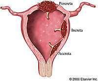 Problemas de la placenta: Acretismo y placenta previa gr46-midi