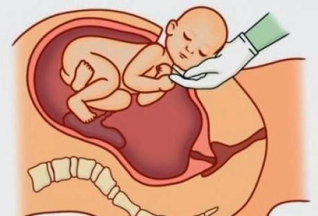 PARTO POR CESÁREA PARTO POR CESÁREA