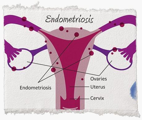 ENDOMETRIOSIS