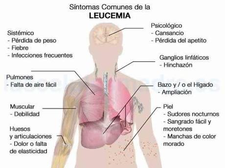 Logran frenar la leucemia con un autoataque de celulas sanas.