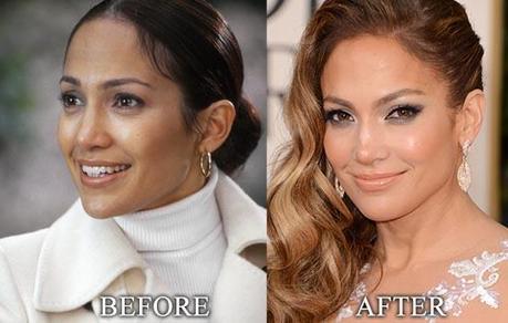 Jennifer-Lopez-botox