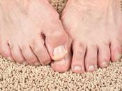 Hongos pies, ¿qué tengo hacer?