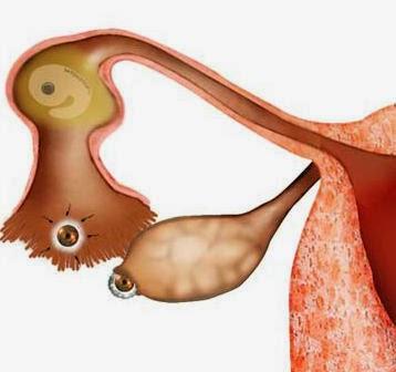 EMBARAZO ECTÓPICO EMBARAZO ECTÓPICO