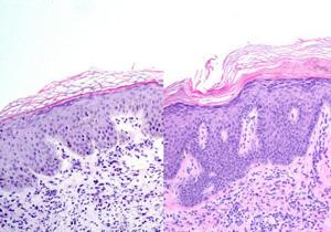 Epidermis humana transplantada en ratón con signos de psoriasis (izquierda) y sin alteraciones cuando se trata con bloqueantes del microRNA miR-21 (derecha). / CNIO