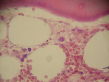 El Trasplante Haploidéntico