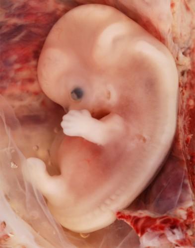 Formas de embarazo ectópico