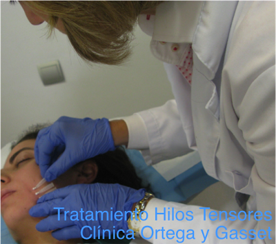 Tratamiento con hilos mágicos