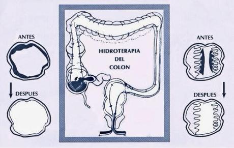 HIDROTERAPIA DEL COLON