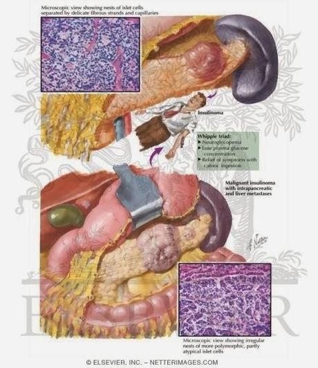 Insulinoma y pancreatoctomía