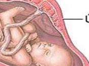 Problemas placenta: DPPNI