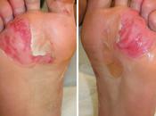 Lesiones cutáneas corredores larga distancia cómo evitarlas