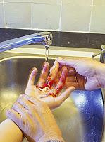 Cómo evitar la infección de una herida en los niños