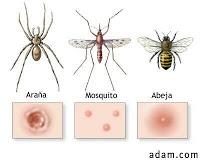 PICADURAS DE INSECTOS