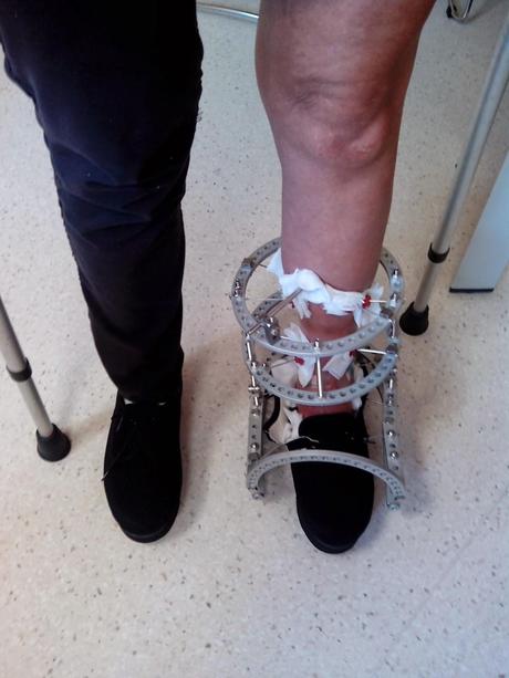 CIRUGÍA CONSERVADORA DE LA ARTICULACIÓN DEL TOBILLO. ÚLTIMOS AVANCES