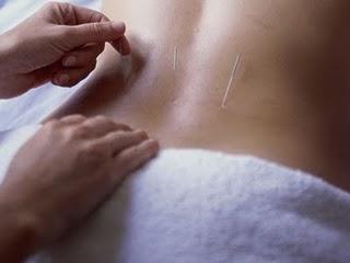 No está demostrado que la acupuntura elimine las náuseas durante el embarazo