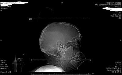 Complicaciones por abuso de drogas y alcohol