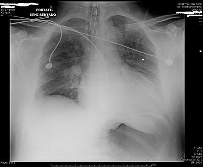 Complicaciones por abuso de drogas y alcohol
