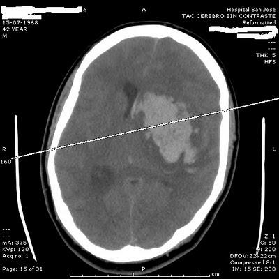 Complicaciones por abuso de drogas y alcohol