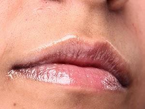 ¿Qué es el Herpes Labial?