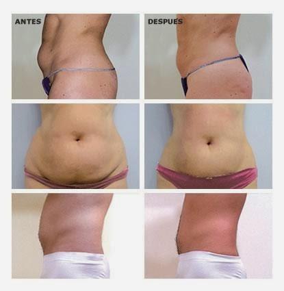 QUE ES LA YESOTERAPIA