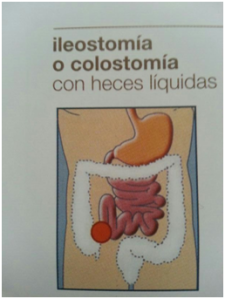 colostomia con heces liquidas