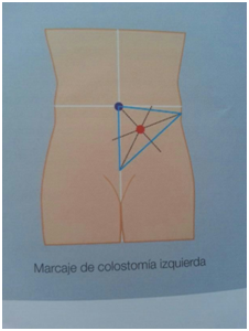 Marcaje colostomia izquierda