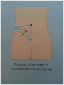 marcaje ileostomia tipo Bricker