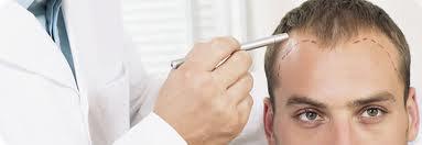 svensona1 Microinjerto capilar para cejas, barba y entradas de cuero cabelludo