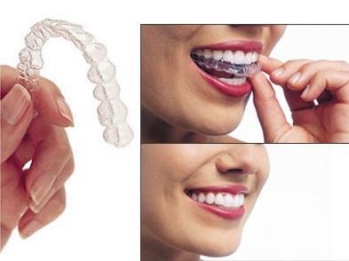 Los beneficios de la ortodoncia van más allá de la estética Invisalign