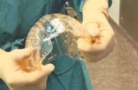 Implantaron un craneo impreso en 3D.