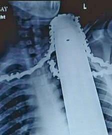 Se clava una motosierra hasta el cuello y sobrevive