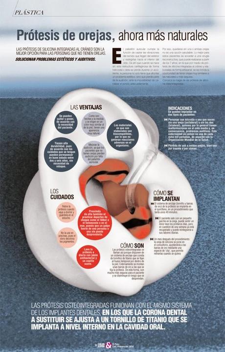 Prótesis de orejas #Infografía #Medicina #Salud